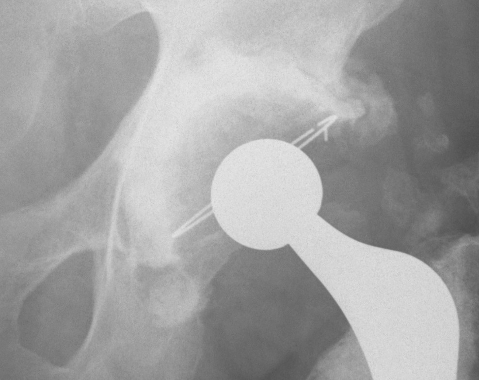 Cemented Cup Lysis Zone 1